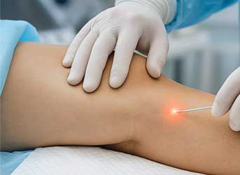 Cirurgia de varizes a laser