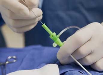 Cirurgia de varizes com Endolaser para safena