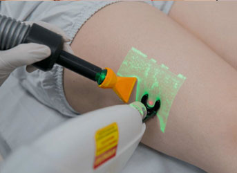 CLACS - Criolaser e laser transdérmico para vasinhos e microvarizes