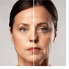 Tratamento a laser para flacidez facial
