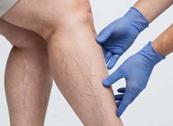 Obesidade e circulação, angiologista e cirurgião vascular em curitiba