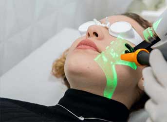 Tratamento a laser para vasinhos na face