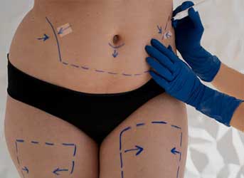 Flacidez Corporal em Curitiba - Endolift, Angiologista e Cirurgião Vascular