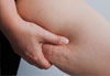 Tratamento de lipedema